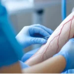 Chicago Vein Centers in Oakbrook