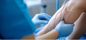 Chicago Vein Centers in Oakbrook