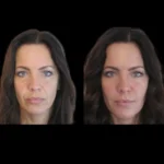 h7-jawline-fillers-ezgif.com-webp-to-jpg-converter