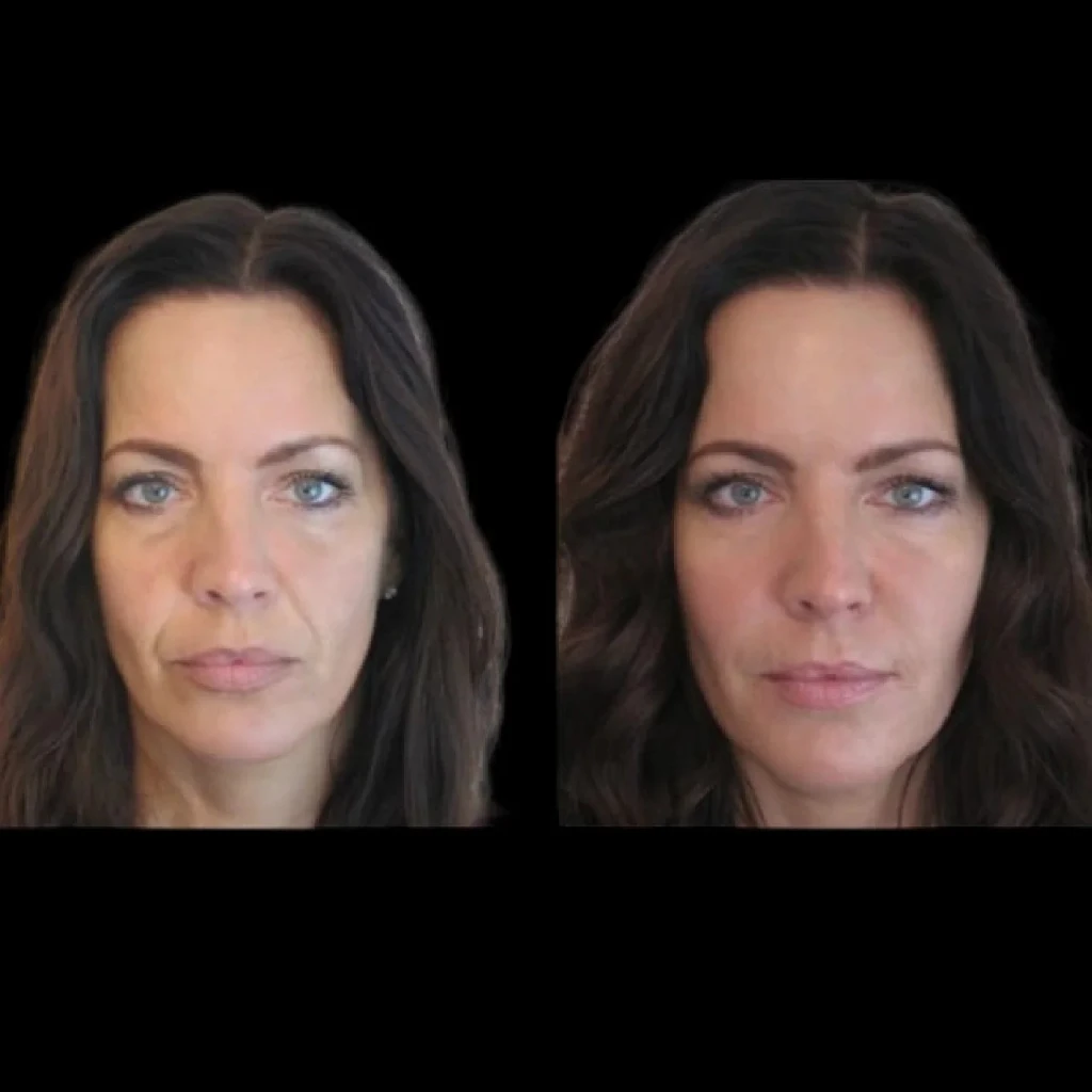 h7-jawline-fillers-ezgif.com-webp-to-jpg-converter