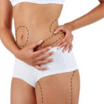 Laser liposuction in Dubai