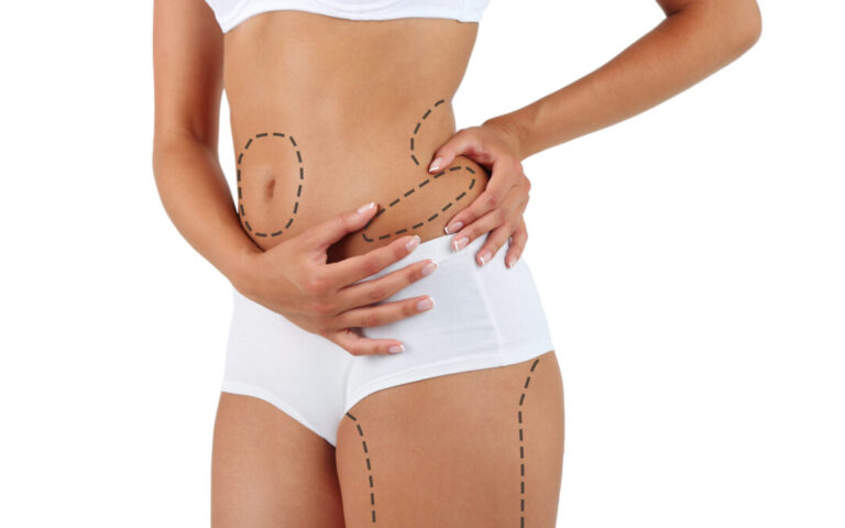 Laser liposuction in Dubai
