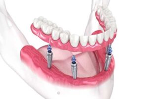 Dental implants Barnstaple 