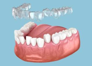 Invisalign lisburn