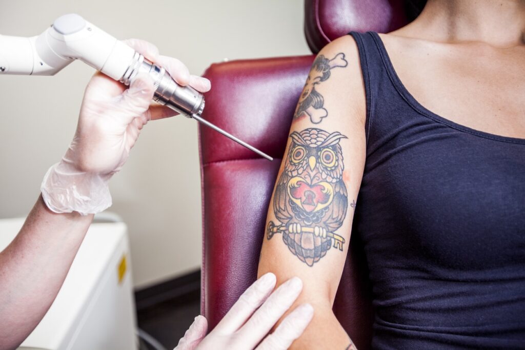 Laser Tattoo Removal in Dubai