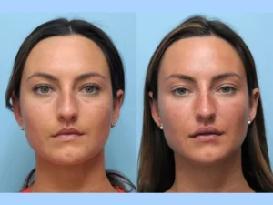 Aesthetic Excellence at the Best Aesthetic Clinic in Dubai for Thread Lift