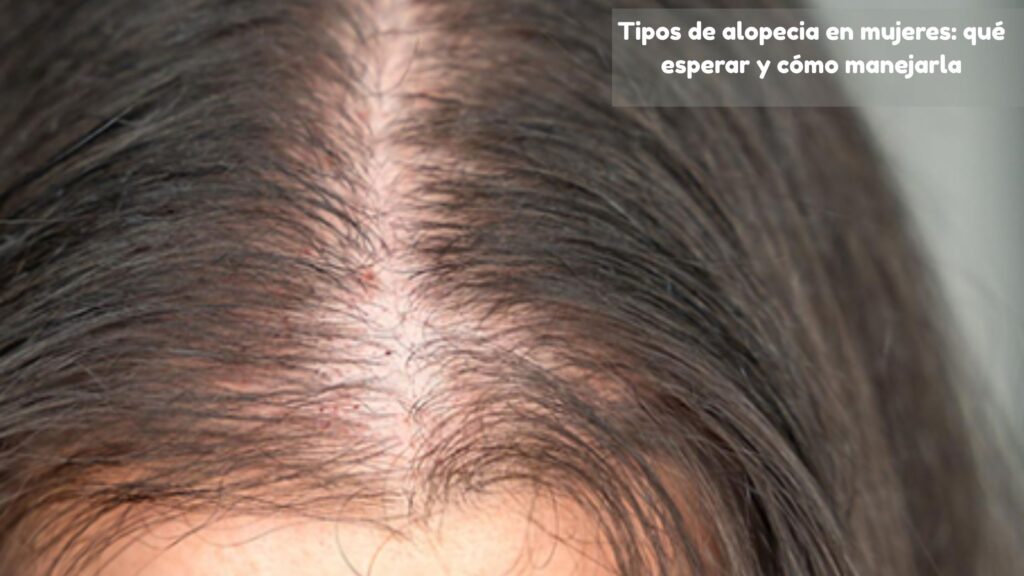 tipos de alopecia en mujeres