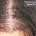 tipos de alopecia en mujeres