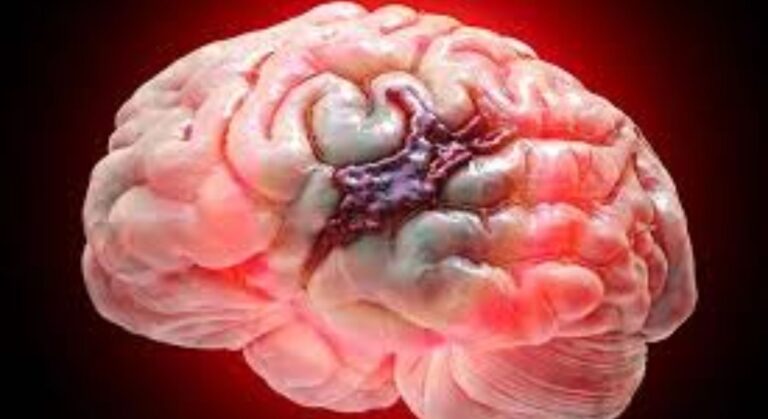 Brain hemorrhage image