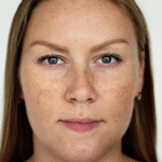 Can Dermal Pigmentation Removal Improve Skin Glow?