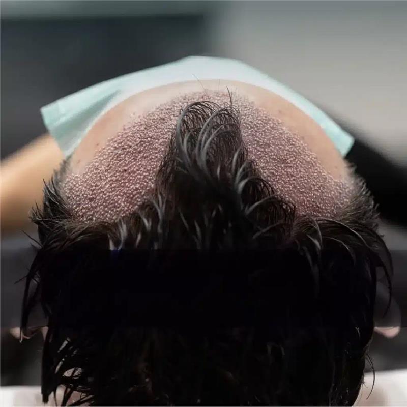 Can Foreigners Get Hair Transplants in Dubai Easily