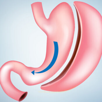 Gastric sleeve surgery in Riyadh