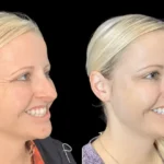 H1-Botox