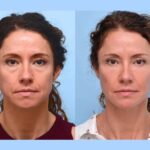 Can Thread Lift in Dubai Replace Traditional Facelifts?