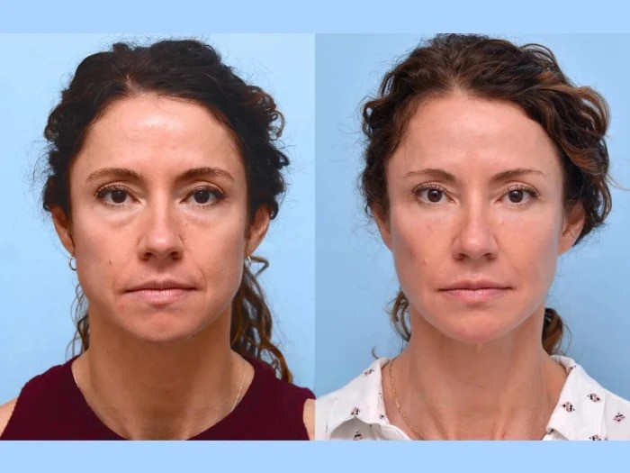 Can Thread Lift in Dubai Replace Traditional Facelifts?