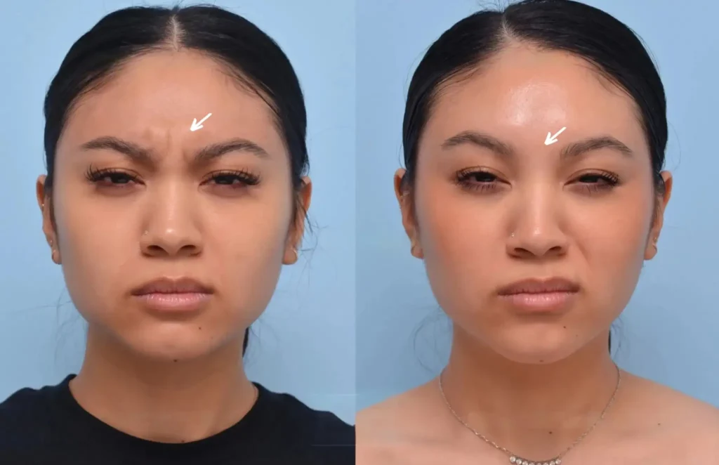Botox for a Youthful Glow: Discover the Best Aesthetic Clinics in Dubai