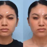 Botox for a Youthful Glow: Discover the Best Aesthetic Clinics in Dubai