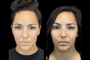 Best Plastic Surgeons in Dubai Reveal the Truth About Botox Myths