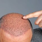 hair clinic in Pune