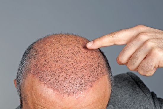 hair clinic in Pune