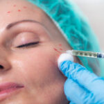 Vampire Facial in Dubai