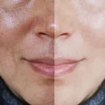 How to Get Rid of Dead Skin on Your Face