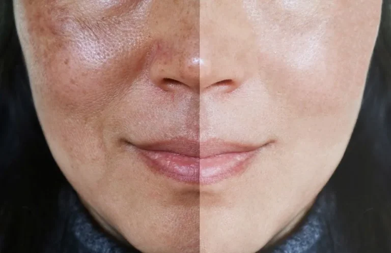 How to Get Rid of Dead Skin on Your Face