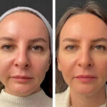 Mesotherapy