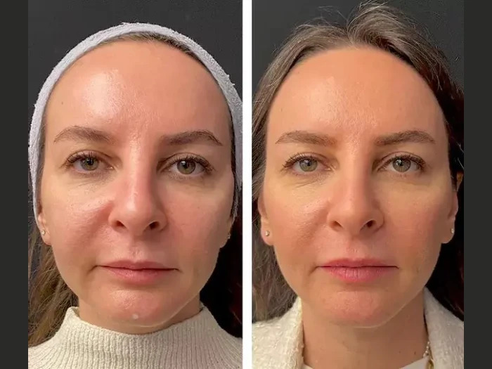 Mesotherapy