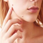 Mole Removal Islamabad