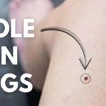 mole on legs