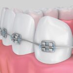 braces for adults