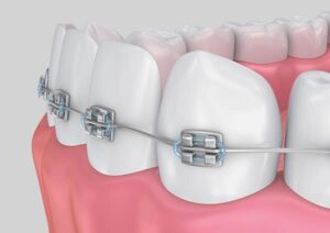 braces for adults