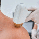 Birthmarks Removal Treatment in Dubai