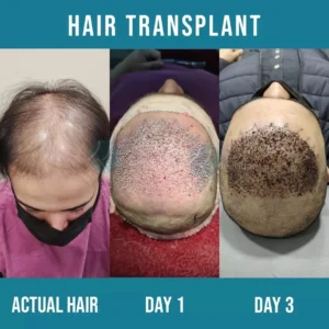 best hair transplant in lahore