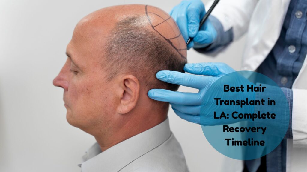 best hair transplant in los angeles