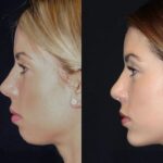 chin-implant-surgery-dubai