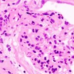 nephrotic-syndrome.
