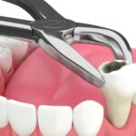 tooth extraction
