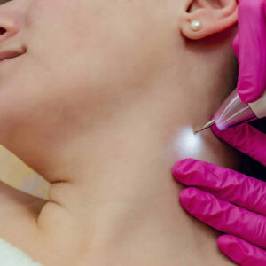 Skin Tag Removal in Dubai