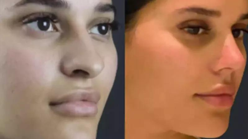 nose surgery in dubai