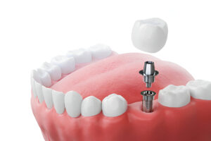 Aftercare Guide for your Dental Implants in Taylor, TX