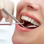 Dental Tooth Filling Dubai