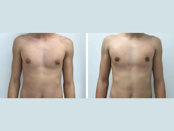 Gynecomastia Surgery in dubai