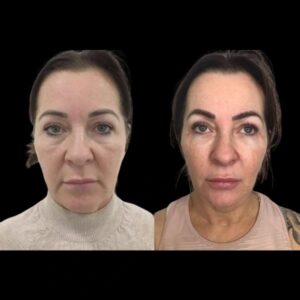 The Benefits of Choosing the Best Doctors in Dubai for Profhilo for Younger Skin