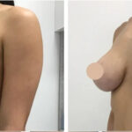 breast lift in dubai