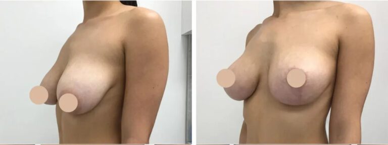 breast lift in dubai