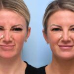 botox in dubai