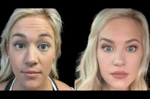 Botox in dubai