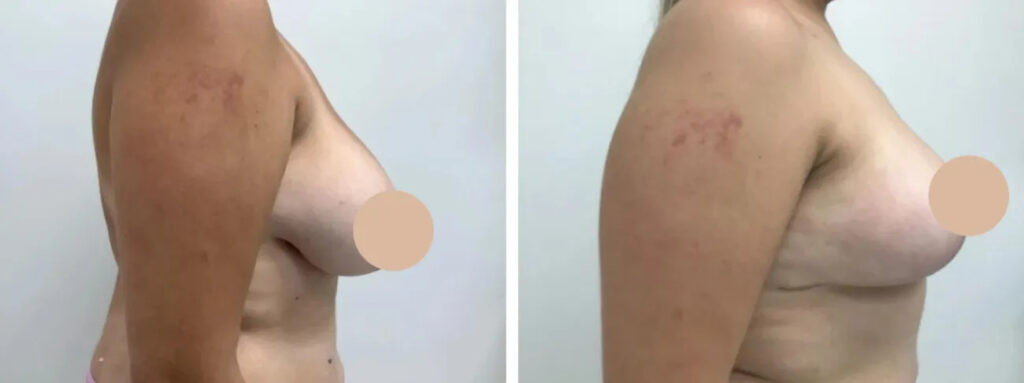 breast reduction in dubai